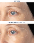 Before-and-after comparison of a woman's eye area showing wrinkle reduction around the outer corner, with text reading BEFORE, IMMEDIATELY AFTER, and dotted circles highlighting the treated area.
