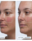 Before and after of using Vitamin C