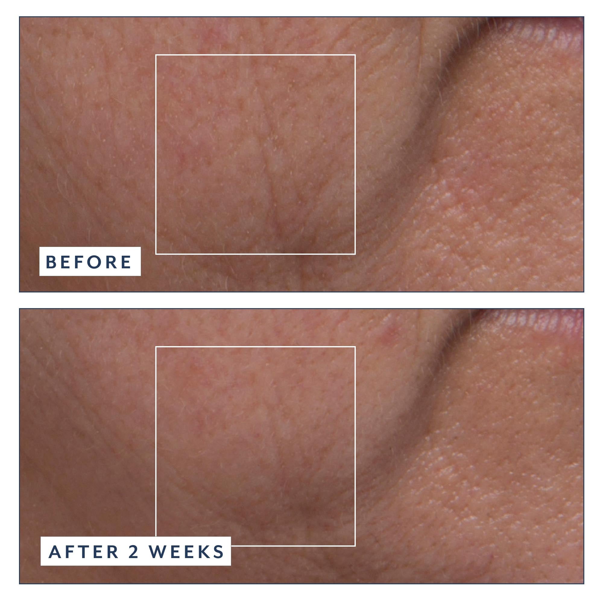 Before and after comparison of skin texture with a close-up showing improvement over 2 weeks.