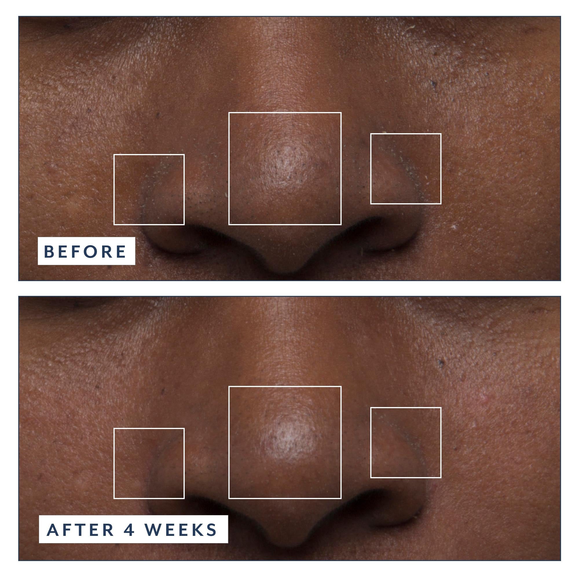 Before and after comparison of skin texture on a person's face, showing improvement over 4 weeks.