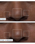 Before and after comparison of skin texture on a person's face, showing improvement over 4 weeks.