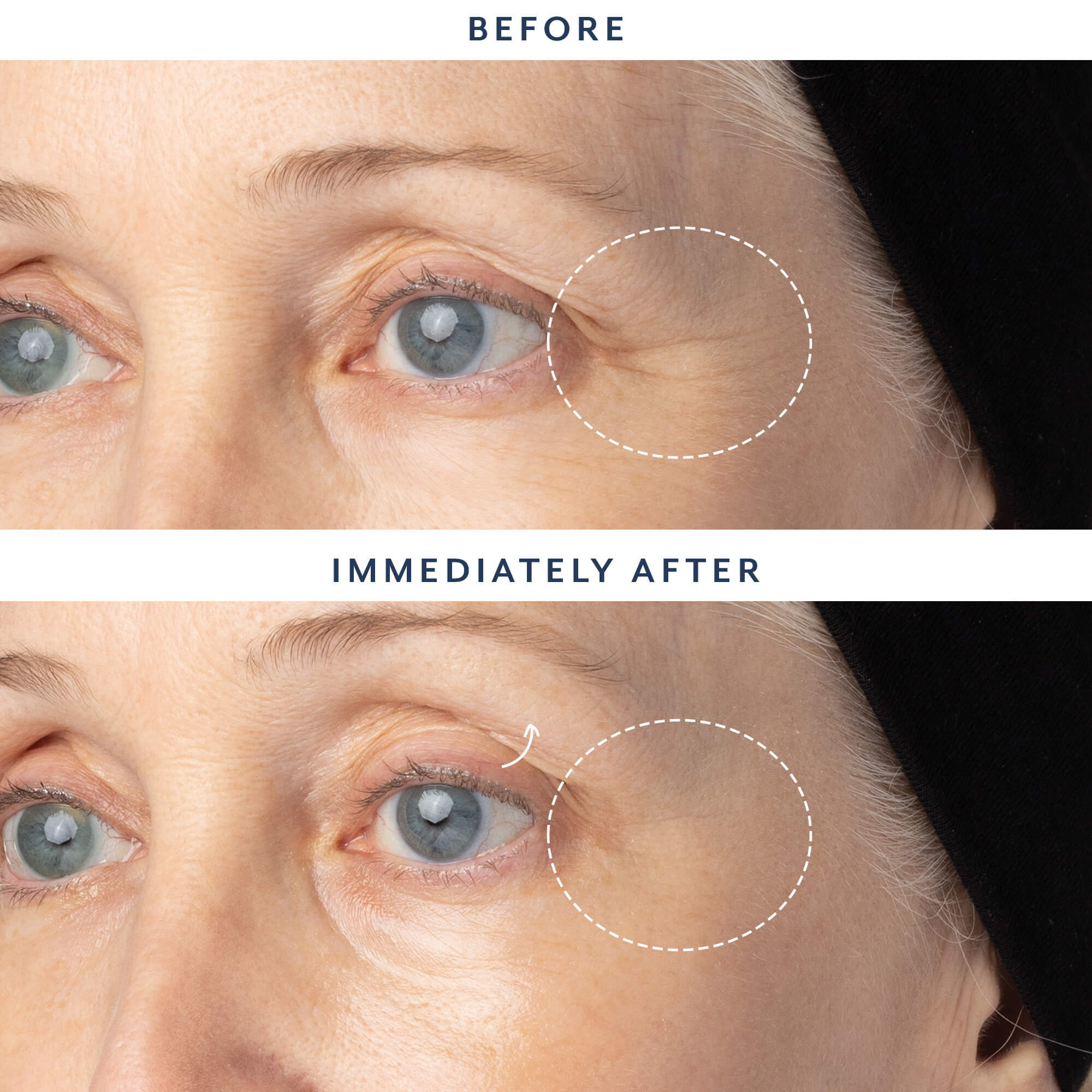 Before-and-after comparison of a woman's eye area showing wrinkle reduction around the outer corner, with text reading BEFORE, IMMEDIATELY AFTER, and dotted circles highlighting the treated area.