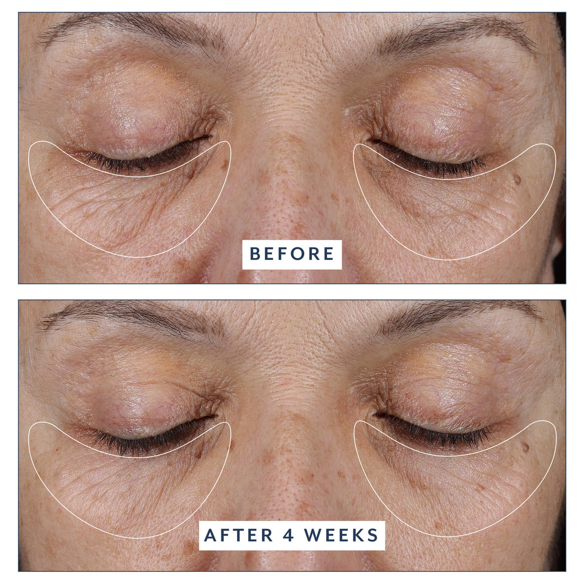Before and after 4 weeks: front-on close-up of a woman's closed eyes, with the under-eye area of both eyes outlined in white, after using Black Tulip Regenelift Eye.