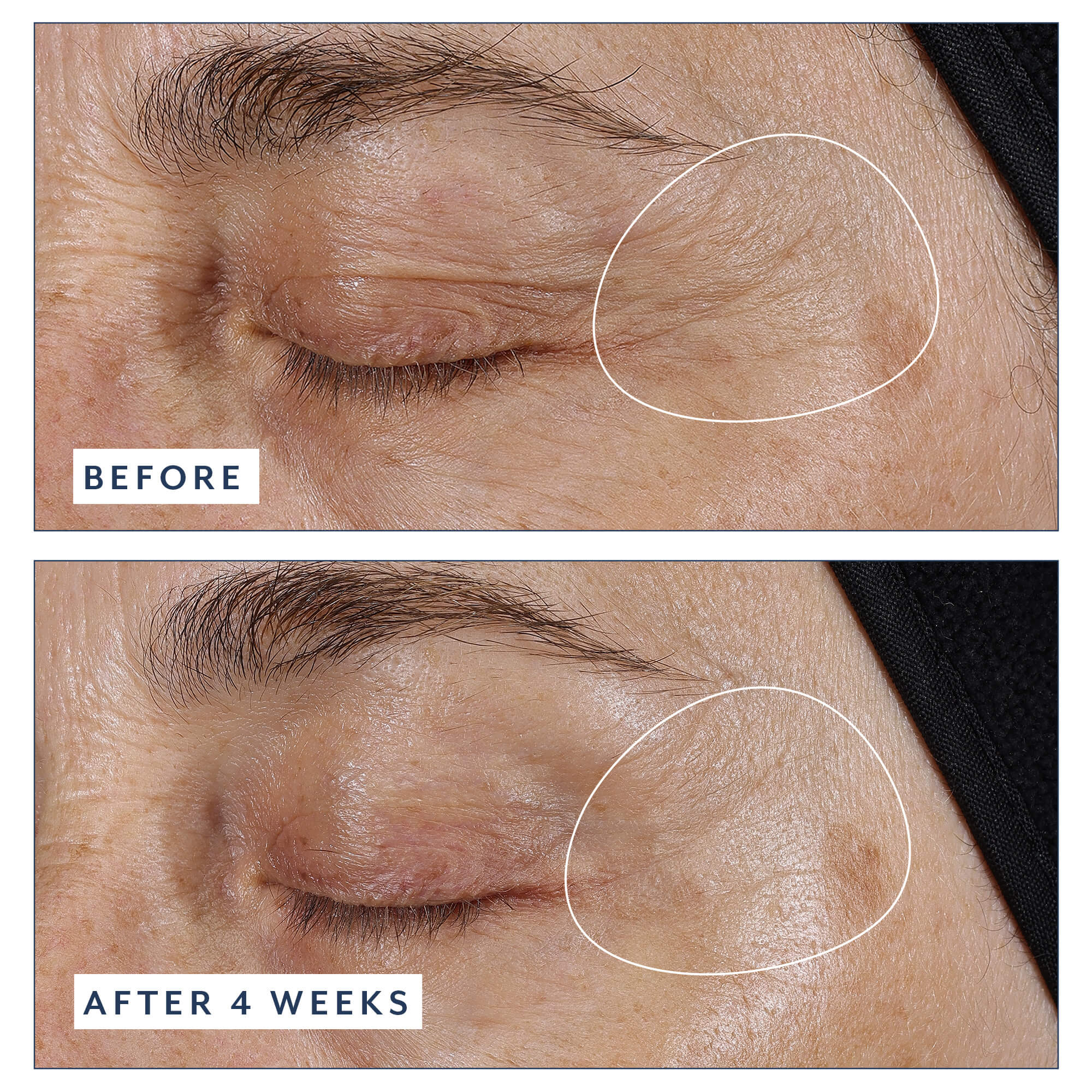 Before and after 4 weeks: angled close-up of a woman's closed left eye, with the outer corner and crow's feet area outlined in white, after using Black Tulip Regenelift Eye.