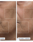 Before and after comparison of skin texture on a person's face