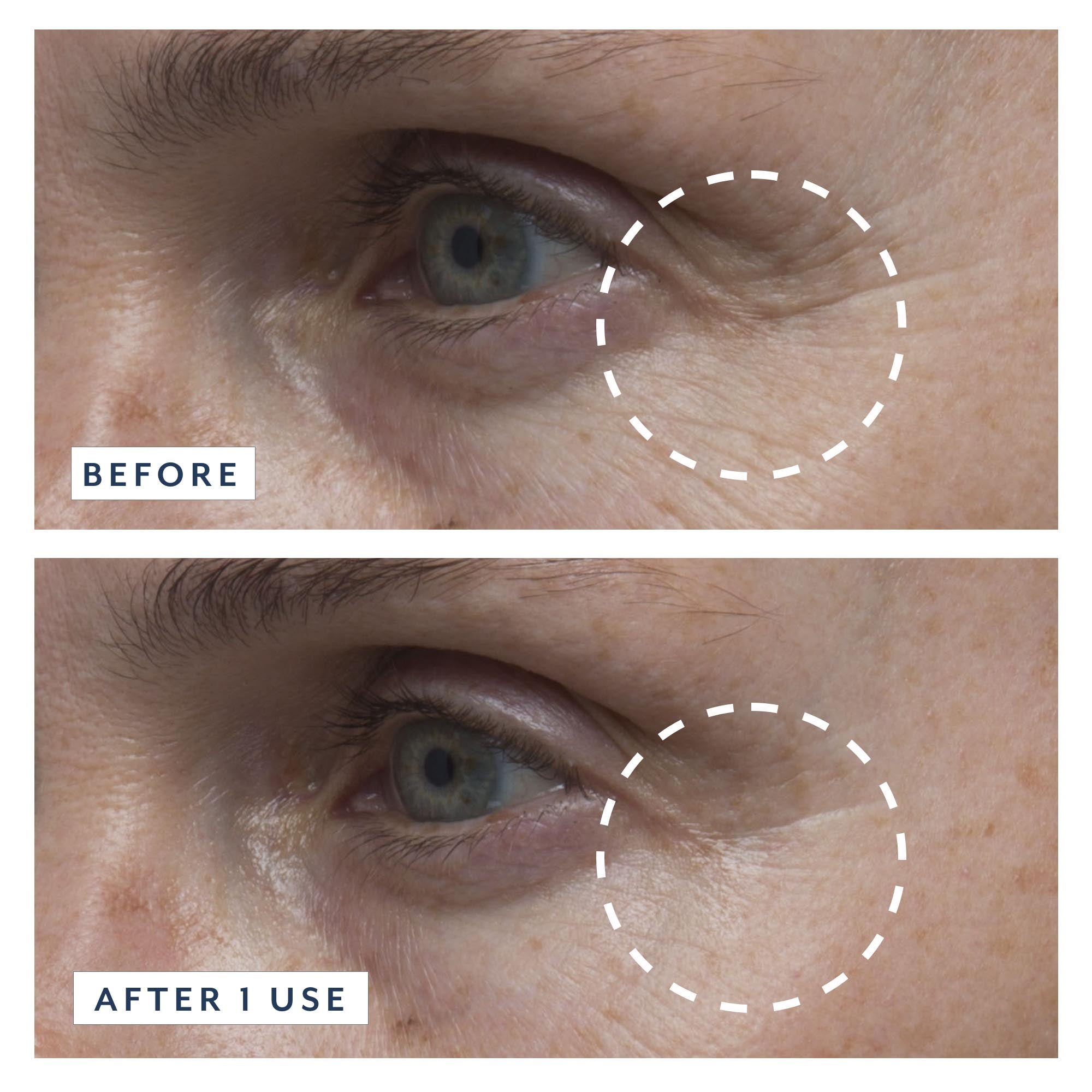 Before and after comparison of skin texture on a person's face