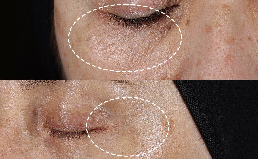Close-up after image of a person's closed eye and surrounding skin, with a white dashed oval highlighting visibly reduced wrinkles.