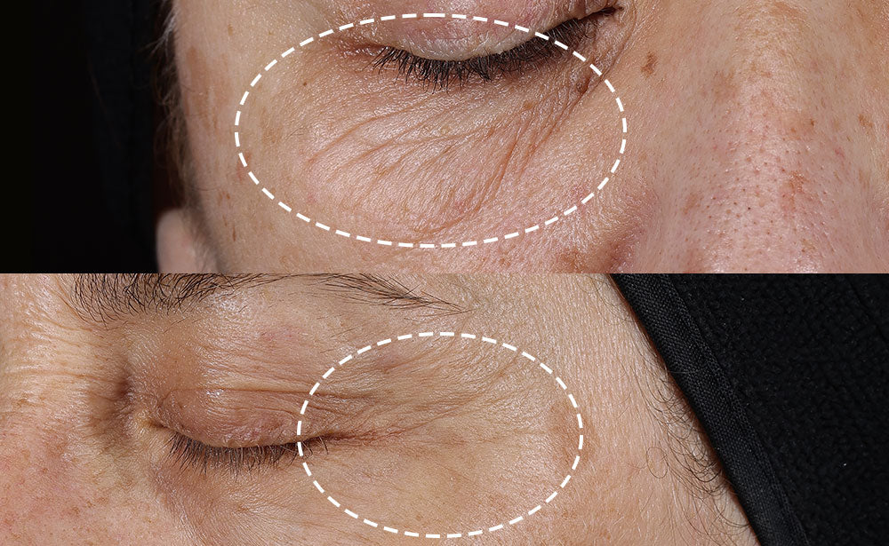 Close-up before image of a person's closed eye and surrounding skin, with a white dashed oval highlighting wrinkles.